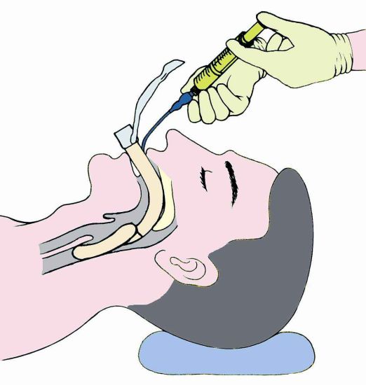 Disposable Medical Laryngeal Mask Airway with High Quality gallery image 4